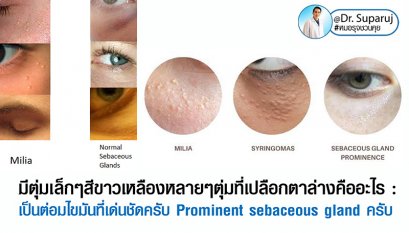 มีตุ่มเล็กๆสีขาวเหลืองหลายๆตุ่มที่เปลือกตาล่างคืออะไร : เป็นต่อมไขมันที่เด่นชัดครับ Prominent sebaceous gland ครับ